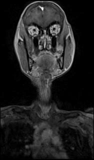 Bilateral carotid body tumors and right glomus jugulare tumor (Radiopaedia 20024-20060 MRA 4).jpg