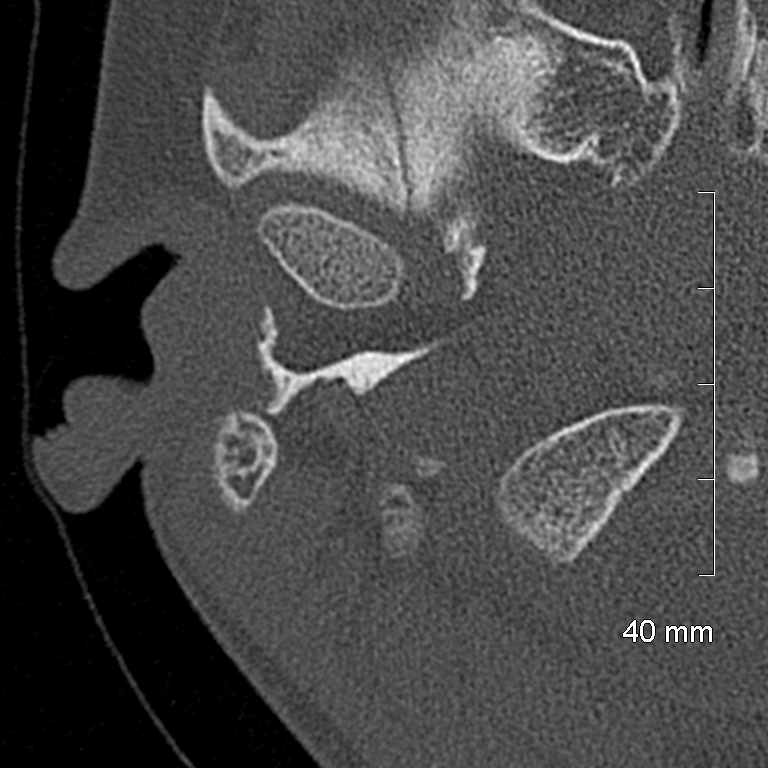 Bilateral grommets (Radiopaedia 47710-52404 Axial bone window 8).jpg
