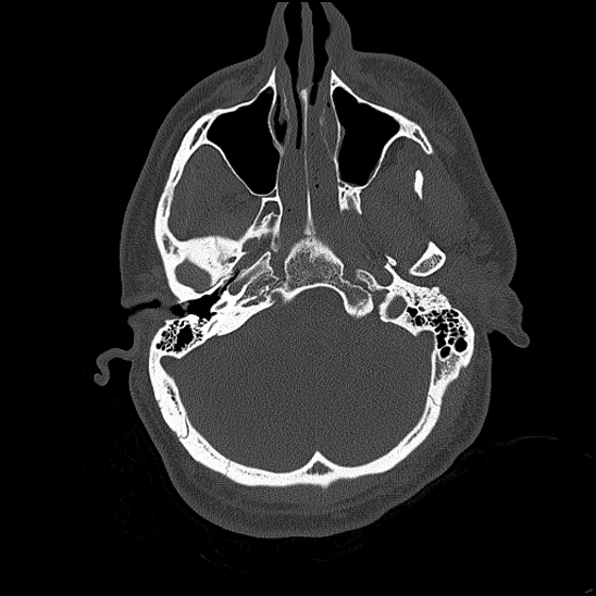 File:Bilateral occipital condyle fracture (type 2) (Radiopaedia 87675-104089 Axial bone thins 50).jpg