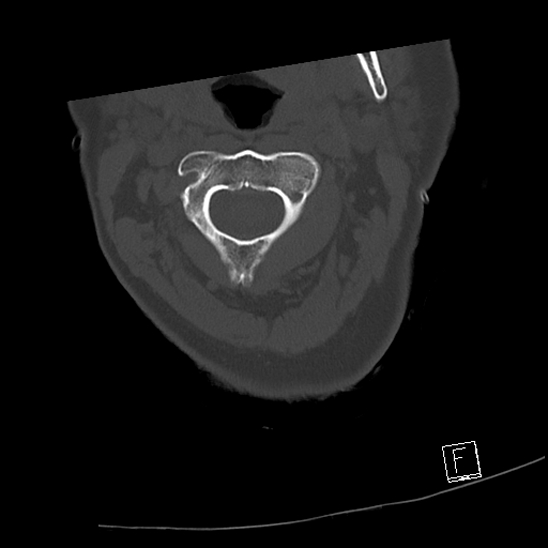 Bilateral occipital condyle fractures (type 3) (Radiopaedia 87672-104086 Axial bone window 23).jpg