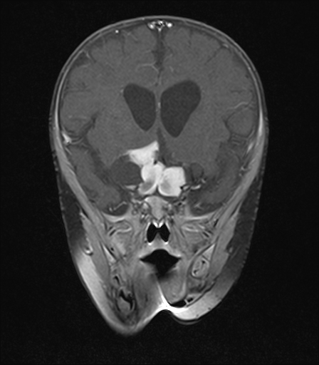 File:Bilateral optic pathway gliomas (Radiopaedia 40013-42514 D 7).jpg