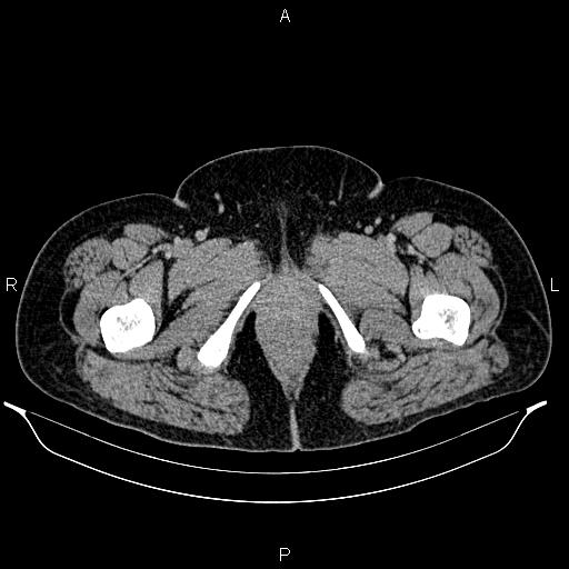 Bilateral ovarian dermoid cysts (Radiopaedia 85785-101603 A 116).jpg