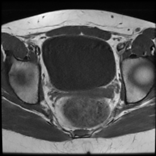 File:Bilateral ovarian fibrothecomas - adolescent (Radiopaedia 86604-102707 Axial T1 20).jpg