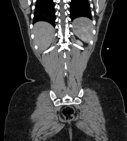 Bilateral ovarian mature cystic teratomas (Radiopaedia 79373-92457 B 95).jpg