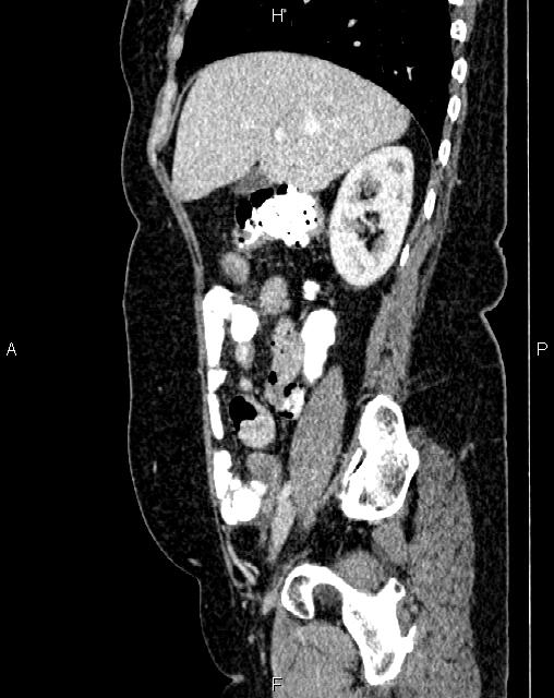 Bilateral ovarian serous cystadenocarcinoma (Radiopaedia 86062-101989 E 22).jpg