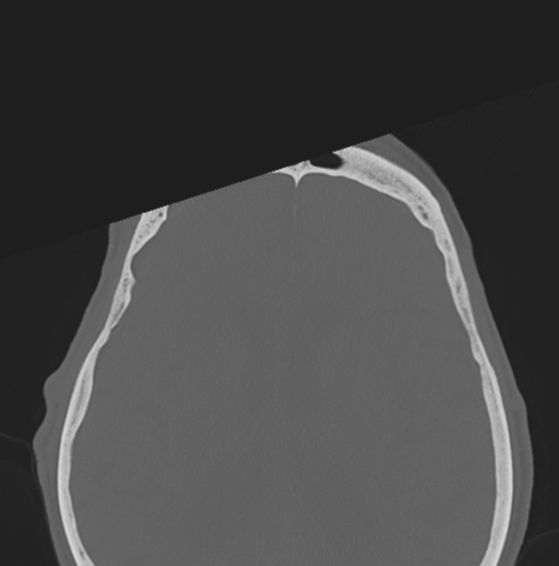 File:Bilateral preseptal periorbital cellulitis (Radiopaedia 43081-46350 Axial bone window 5).png