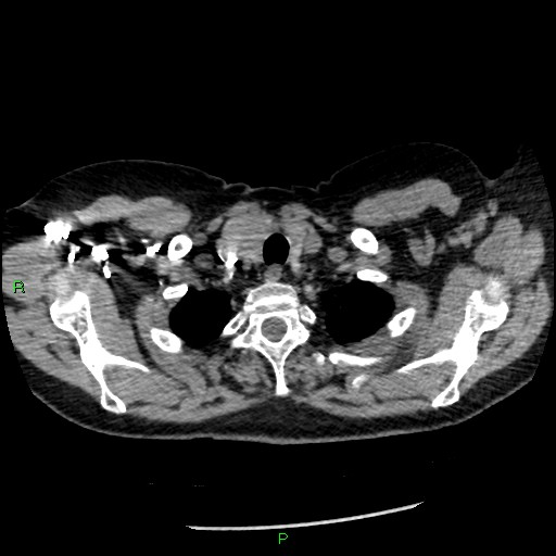 Bilateral pulmonary emboli (Radiopaedia 32700-33669 Axial C+ CTPA 8).jpg