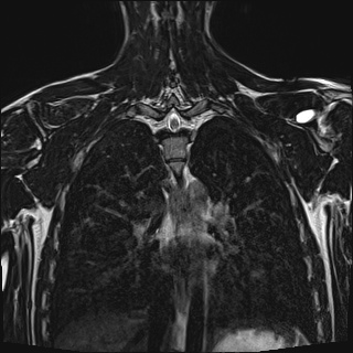 Bilateral spinoglenoid notch ganglion cysts (Radiopaedia 29577-30082 Coronal T2 85).jpg