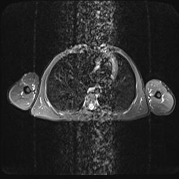 File:Bilateral spinoglenoid notch ganglion cysts (Radiopaedia 29577-30082 E 24).jpg