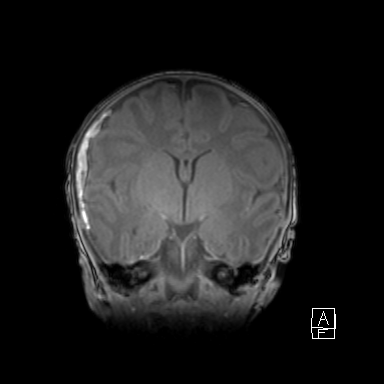 Bilateral subdural hemorrhage and parietal skull fracture (Radiopaedia 26058-26190 Coronal T1 25).png