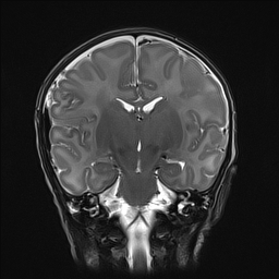 File:Bilateral subdural hemorrhage and parietal skull fracture (Radiopaedia 26058-26190 Coronal T2 17).png