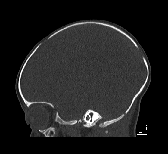 File:Bilateral subdural hemorrhage and parietal skull fracture (Radiopaedia 26058-26192 Sagittal bone window 30).png