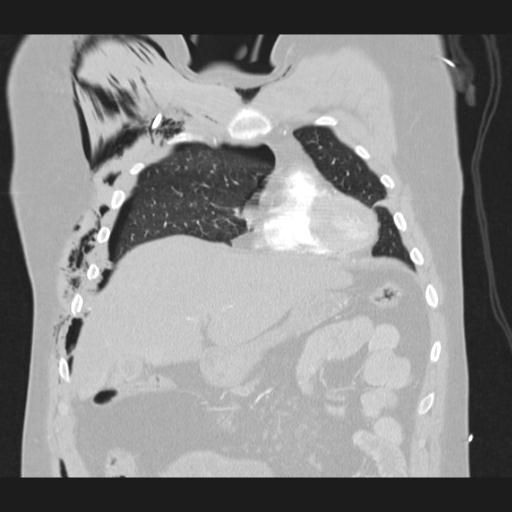 Bilateral traumatic renovascular injury (Radiopaedia 32051-32995 Coronal lung window 23).jpg