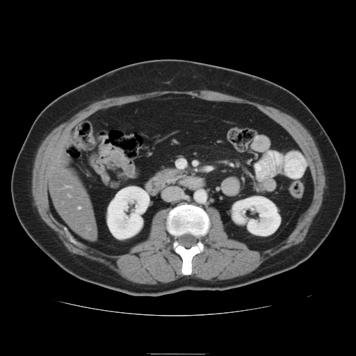 File:Billroth I gastric resection (Radiopaedia 17685-17425 None 22).jpg