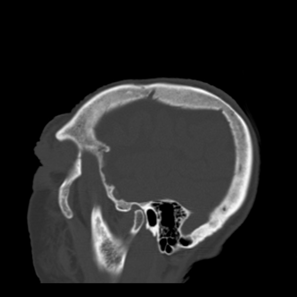 Biparietal osteodystrophy (Radiopaedia 46109-50463 Sagittal bone window 88).jpg