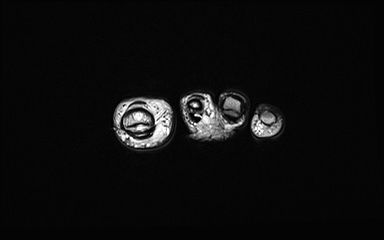Bipartite hallux sesamoid diastasis (Radiopaedia 77133-89109 Coronal PD 43).jpg