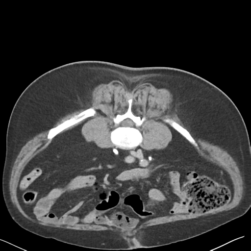 File:Bladder papillary urothelial carcinoma (Radiopaedia 48119-52951 Axial C+ delayed 32).png