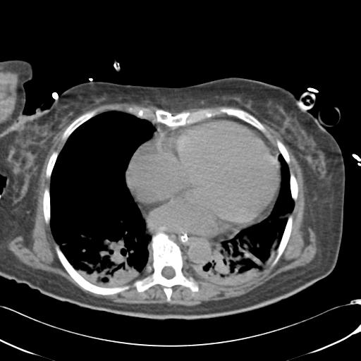 Bladder rupture post renal biopsy (Radiopaedia 30863-31572 Axial non-contrast 3).jpg