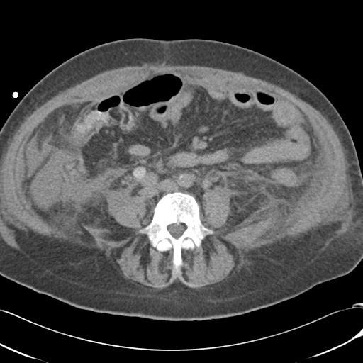 Bladder rupture post renal biopsy (Radiopaedia 30863-31572 Axial non-contrast 53).jpg