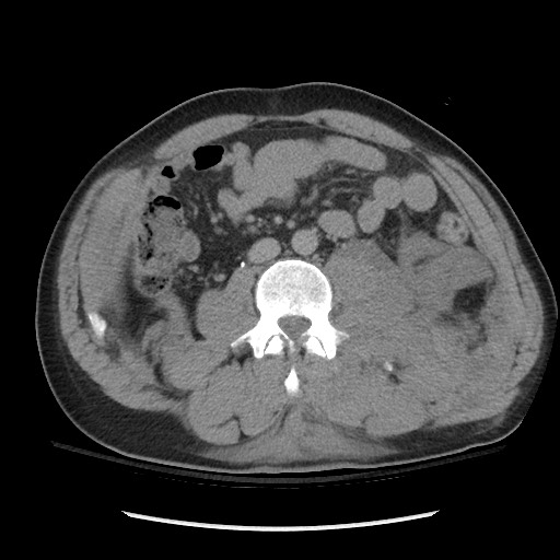 Blunt abdominal trauma with solid organ and musculoskelatal injury with active extravasation (Radiopaedia 68364-77895 Axial C+ delayed 75).jpg