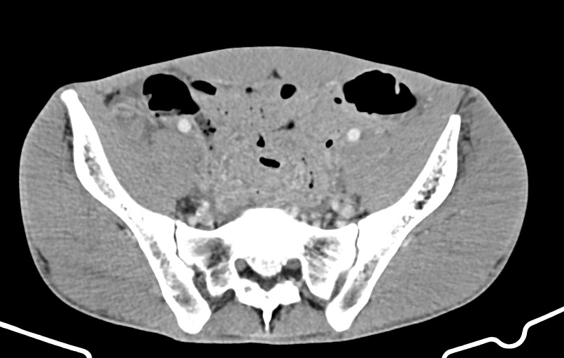 Blunt injury to the small bowel (Radiopaedia 74953-85987 A 151).jpg