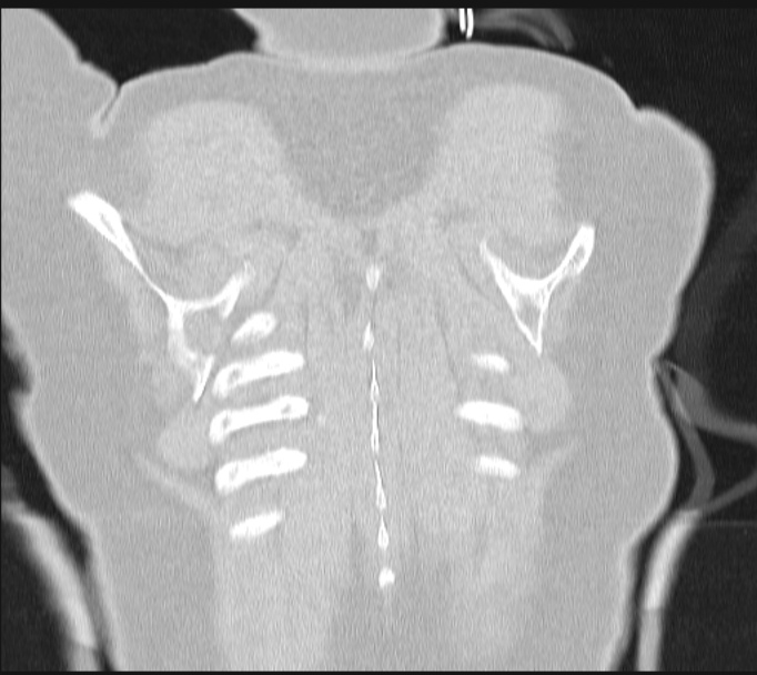 Boerhaave syndrome (Radiopaedia 45644-49799 Coronal lung window 66).jpg