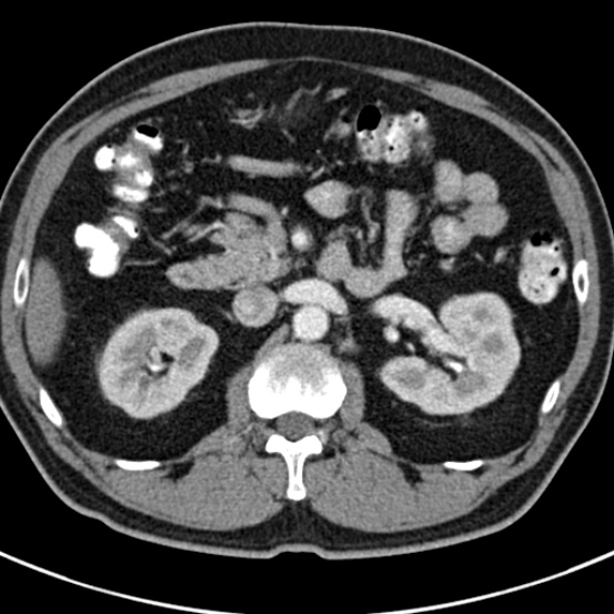 File:Bosniak cyst - type IV (Radiopaedia 23525-23627 renal cortical phase 20).jpg
