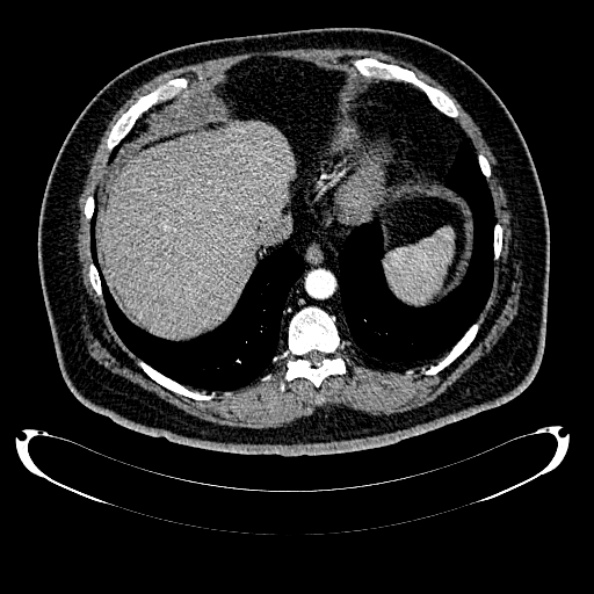 File:Bosniak renal cyst - type IV (Radiopaedia 24244-24518 B 29).jpg