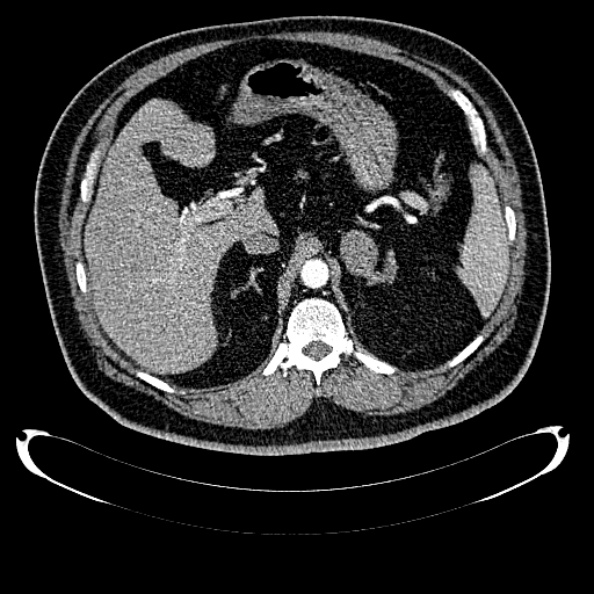 Bosniak renal cyst - type IV (Radiopaedia 24244-24518 B 83).jpg