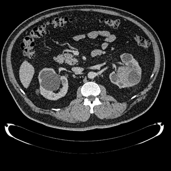 Bosniak renal cyst - type IV (Radiopaedia 24244-24518 C 141).jpg