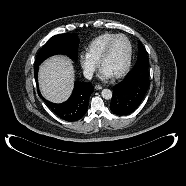 Bosniak renal cyst - type IV (Radiopaedia 24244-24518 C 2).jpg