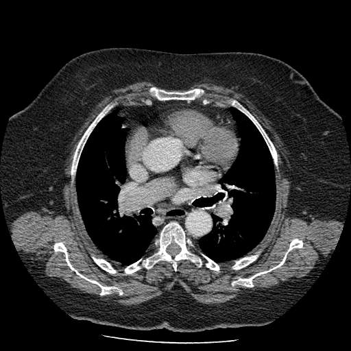 Bovine aortic arch - right internal mammary vein drains into the superior vena cava (Radiopaedia 63296-71875 A 70).jpg