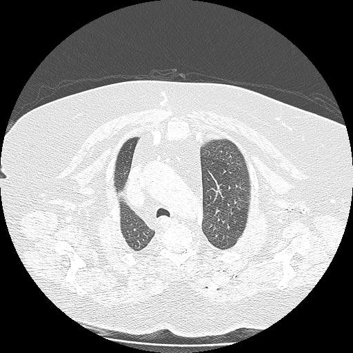 Bovine aortic arch - right internal mammary vein drains into the superior vena cava (Radiopaedia 63296-71875 Axial lung window 32).jpg