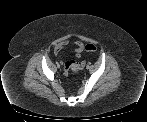 Bowel and splenic infarcts in acute lymphocytic leukemia (Radiopaedia 61055-68913 A 105).jpg