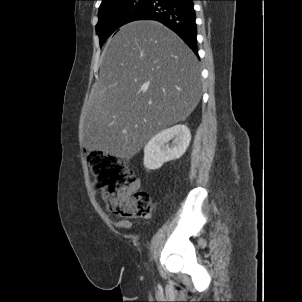 Bowel and splenic infarcts in acute lymphocytic leukemia (Radiopaedia 61055-68915 C 48).jpg