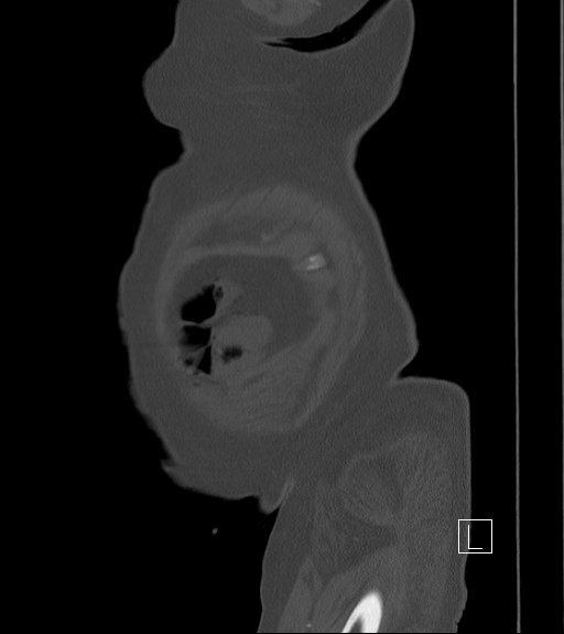 Bowel ischemia secondary to SMA occlusion with extensive portomesenteric venous gas (Radiopaedia 54656-60871 Sagittal bone window 111).jpg