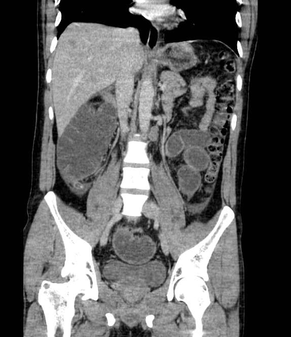 Bowel obstruction from colon carcinoma (Radiopaedia 22995-23028 C 41).jpg