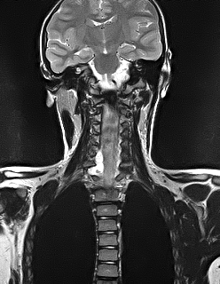 File:Brachial plexus birth palsy (Radiopaedia 68118-77604 Coronal T2 6).jpg