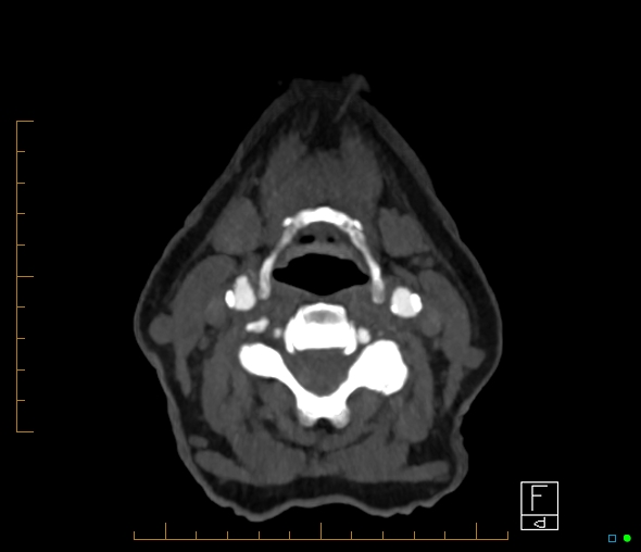 Brachiocephalic trunk stenosis (Radiopaedia 87242-103519 A 95).jpg