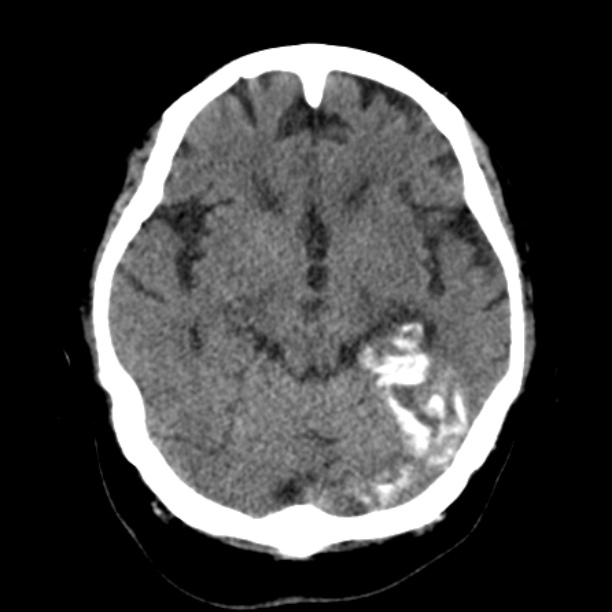 Brain cortical laminar necrosis (Radiopaedia 25822-25971 Axial non-contrast 17).jpg