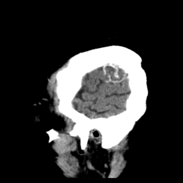 Brain cortical laminar necrosis (Radiopaedia 25822-25971 non-contrast 45).jpg