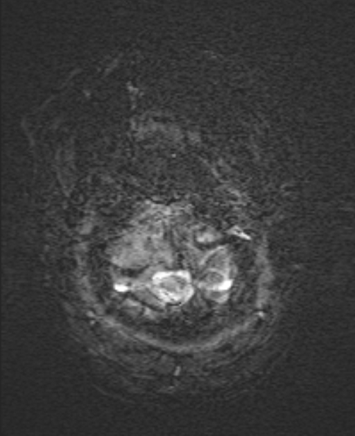 Brain metastases - lung cancer primary (Radiopaedia 75060-86115 Axial SWI 1).jpg