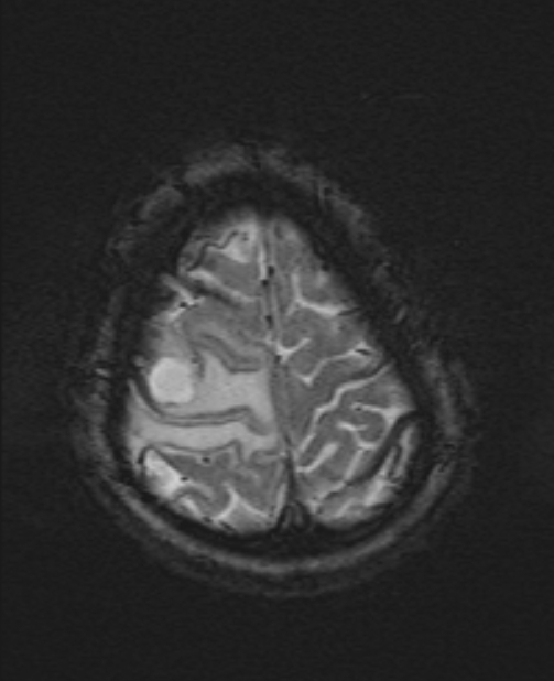 Brain metastases - lung cancer primary (Radiopaedia 75060-86115 Axial SWI 54).jpg
