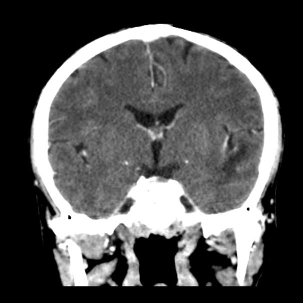 Brain metastases from lung cancer (Radiopaedia 24480-24781 Coronal C+ delayed 30).jpg