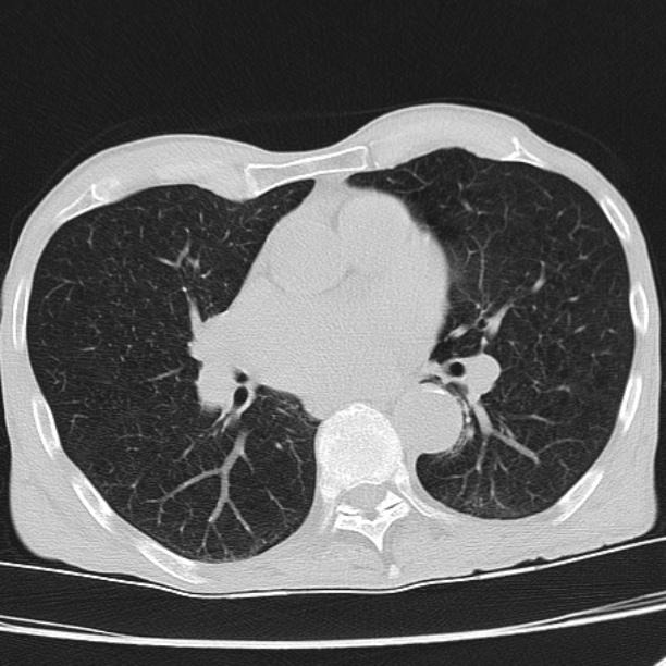 Brain metastases from lung cancer (Radiopaedia 27849-28093 Axial lung window 35).jpg