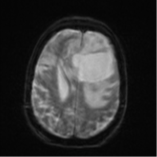 Brain metastasis (lung cancer) (Radiopaedia 48289-53179 Axial DWI 20).png