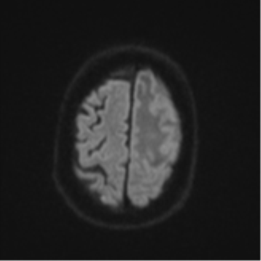 Brain metastasis (lung cancer) (Radiopaedia 48289-53179 Axial DWI 52).png