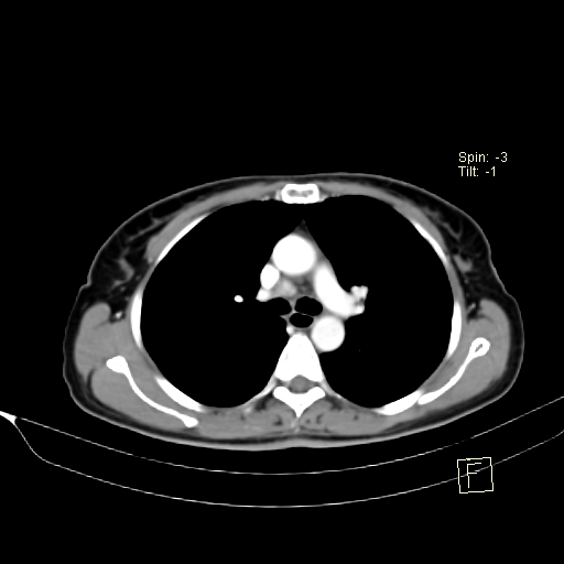 Brain metastasis as initial presentation of non-small cell lung cancer (Radiopaedia 65122-74127 A 19).jpg