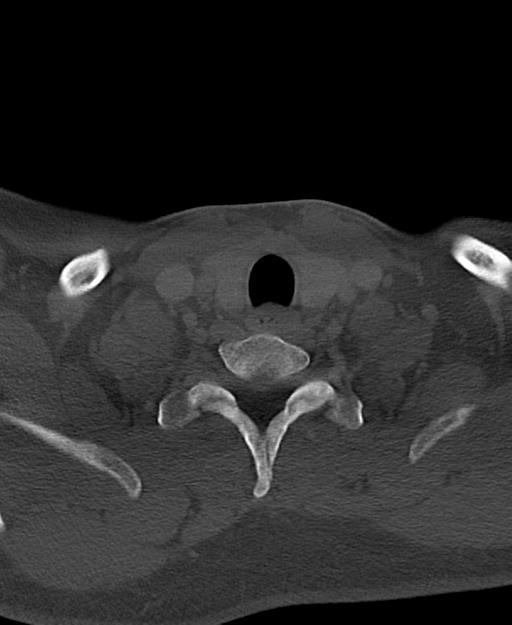 Branchial cleft cyst (Radiopaedia 31167-31875 Axial bone window 62).jpg
