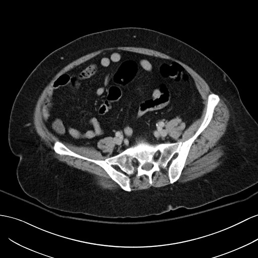 Breast carcinoma with pathological hip fracture (Radiopaedia 60314-67974 B 51).jpg